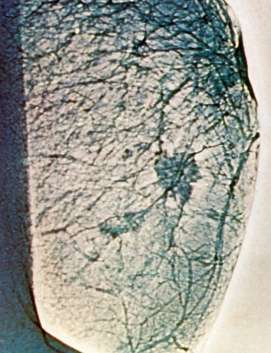 Framed Print : Mammogram showing tumours in the breast tissue Framed Print : Mammogram showing tumours in the breast tissue