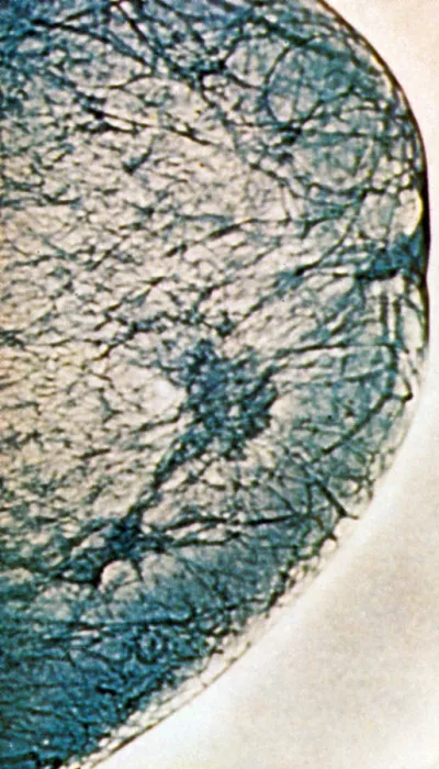 Framed Print : Mammogram showing tumours in the breast tissue Framed Print : Mammogram showing tumours in the breast tissue