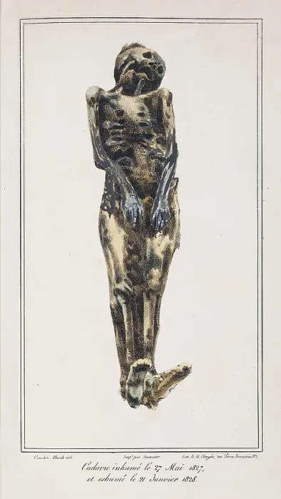 Framed Print : Mathieu Orfila, Decomposition On Exhumed Bodies, 1831 Framed Print : Mathieu Orfila, Decomposition On Exhumed Bodies, 1831