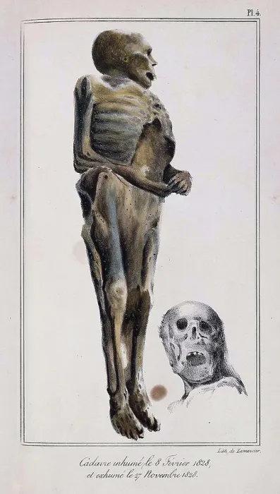 Framed Print : Mathieu Orfila, Decomposition On Exhumed Bodies, 1831 Framed Print : Mathieu Orfila, Decomposition On Exhumed Bodies, 1831