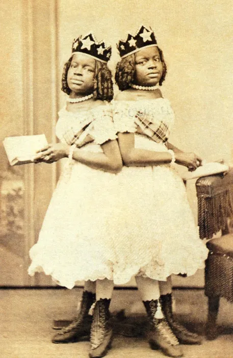 Framed Print : The McCoys, American Conjoined Twins Framed Print : The McCoys, American Conjoined Twins