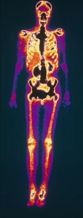 Framed Print : Metastatic Lung Cancer