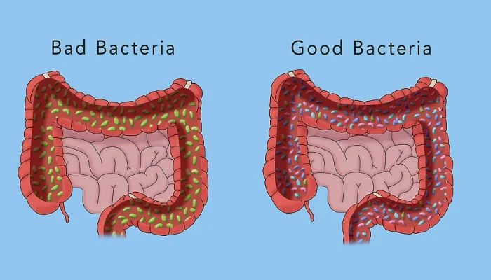 Framed Print : The microbiome of the large intestine, comparison of good and bad bacteria, medical illustration Framed Print : The microbiome of the large intestine, comparison of good and bad bacteria, medical illustration