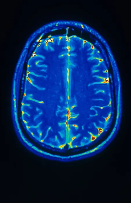 Framed Print : MRI of Brain Framed Print : MRI of Brain