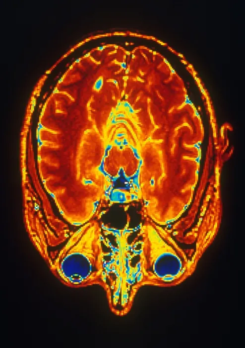 Framed Print : MRI of Brain Framed Print : MRI of Brain