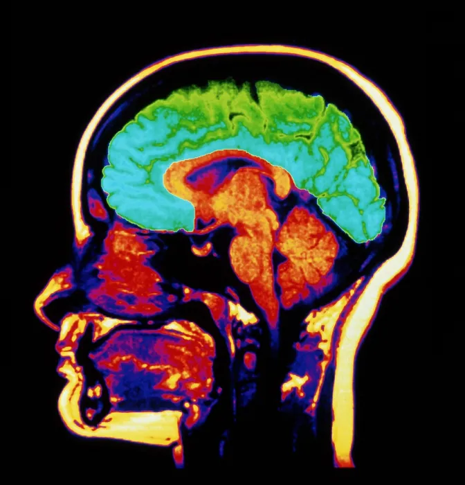 Framed Print : MRI brain scan