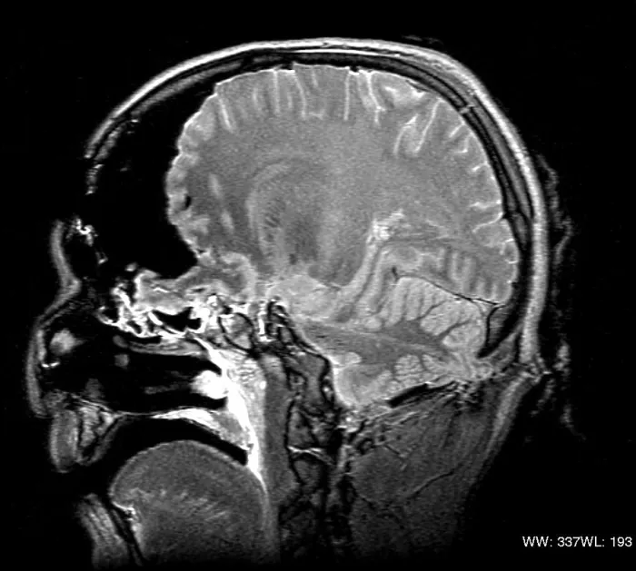 Framed Print : MRI Cross Section, Wound Track