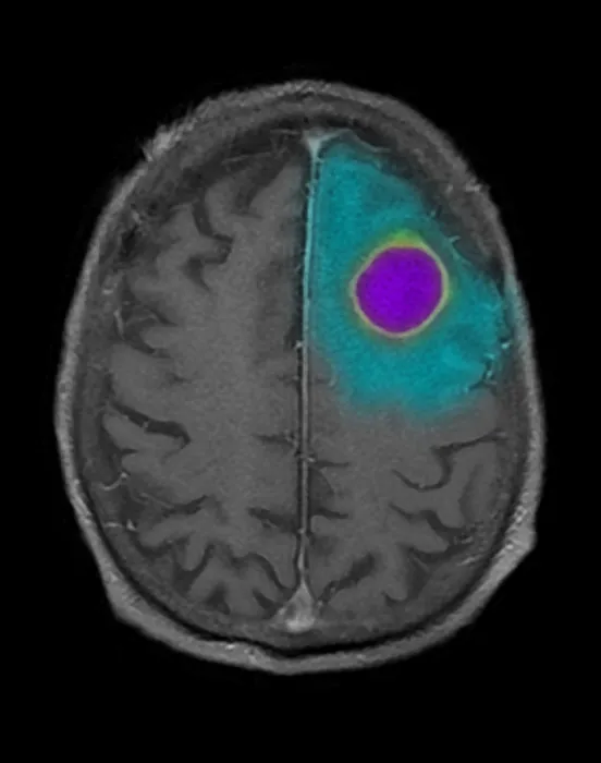 Framed Print : MRI of Encapsulated Abscess in Frontal Lobe Framed Print : MRI of Encapsulated Abscess in Frontal Lobe
