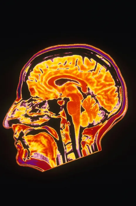 Framed Print : MRI of Head