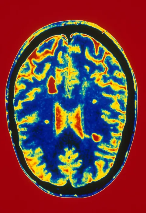 Framed Print : MRI Multiple Sclerosis Framed Print : MRI Multiple Sclerosis