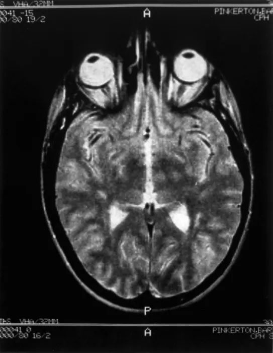 Framed Print : Multiple sclerosis Framed Print : Multiple sclerosis