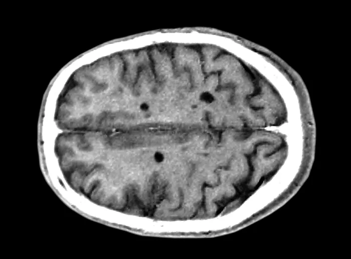 Framed Print : Multiple sclerosis brain lesions