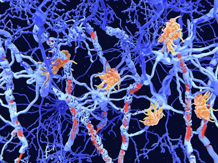Framed Print : Multiple sclerosis (MS): microglia cells damage the myelin sheath of neuron axons Framed Print : Multiple sclerosis (MS): microglia cells damage the myelin sheath of neuron axons