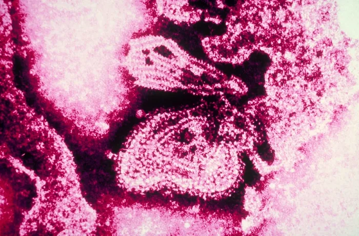 Framed Print : Mumps Virus (TEM)