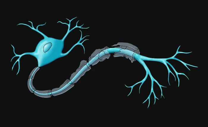 Framed Print : Nerve Demyelination of the myelin sheath, causes include multiple sclerosis (MS) disease, toxins, infections, Illustration Framed Print : Nerve Demyelination of the myelin sheath, causes include multiple sclerosis (MS) disease, toxins, infections, Illustration
