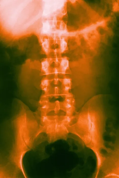Framed Print : Normal Abdomen and Colon