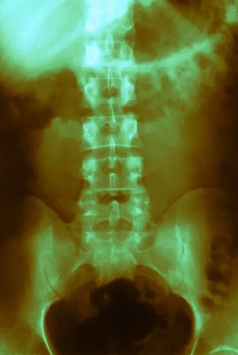 Framed Print : Normal Abdomen and Colon