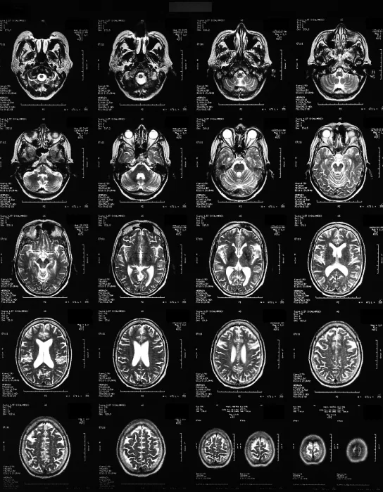 Framed Print : Normal Brain, 62-Year-Old Woman, MRI Framed Print : Normal Brain, 62-Year-Old Woman, MRI