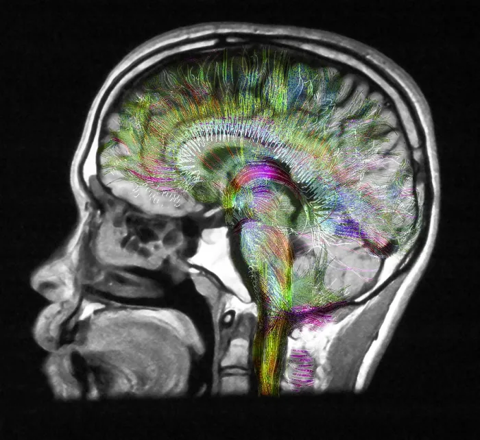 Framed Print : Normal Brain, Fiber Tractography and MRI Framed Print : Normal Brain, Fiber Tractography and MRI