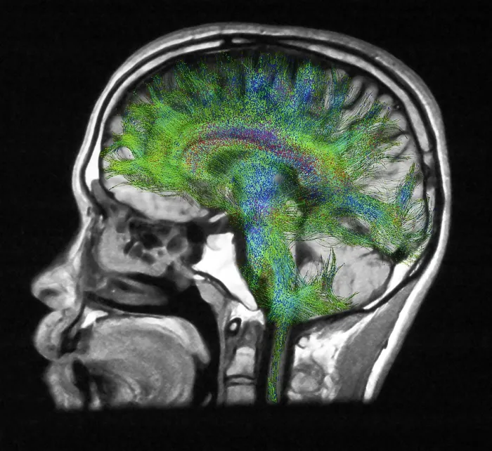 Framed Print : Normal Brain, Fiber Tractography and MRI Framed Print : Normal Brain, Fiber Tractography and MRI