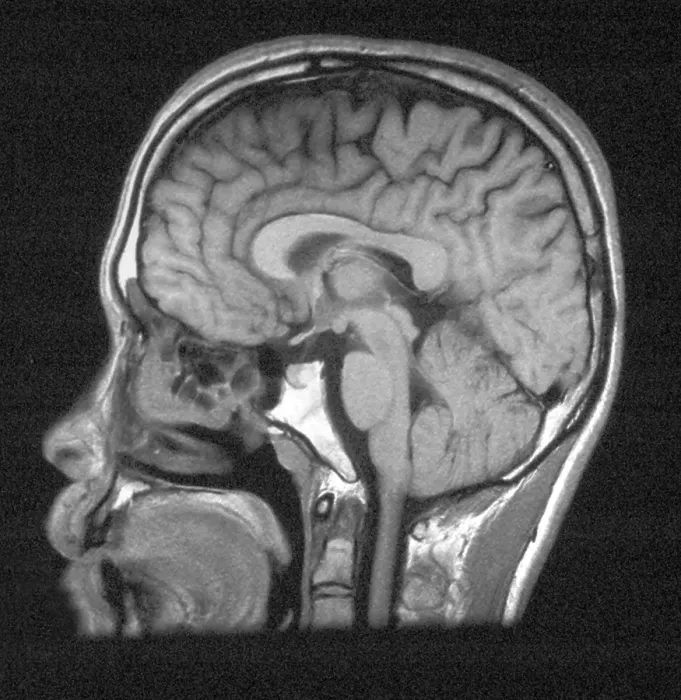 Framed Print : Normal Brain Structures in Head, MRI Framed Print : Normal Brain Structures in Head, MRI