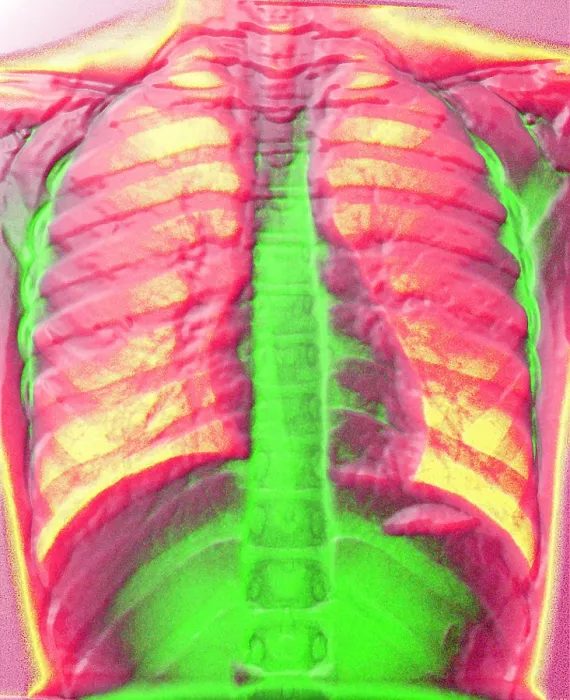 Framed Print : A normal chest X-ray