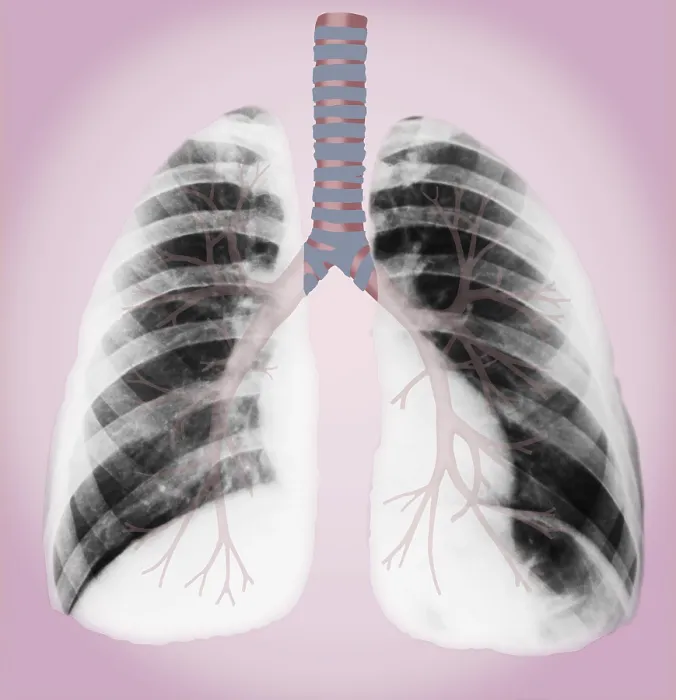 Framed Print : Normal lungs Framed Print : Normal lungs
