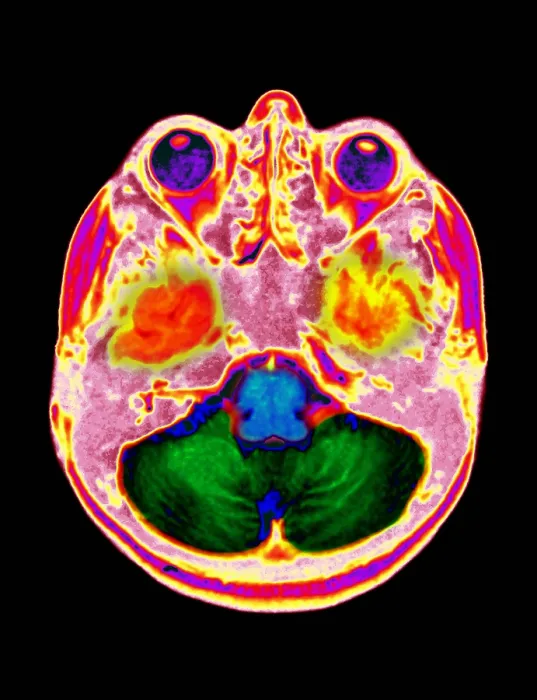 Framed Print : Normal MRI Framed Print : Normal MRI