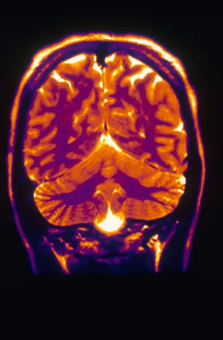 Framed Print : Normal MRI of Brain Framed Print : Normal MRI of Brain