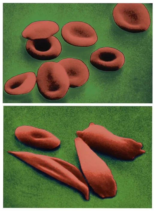 Framed Print : Normal RBCs and Sickle-Cell Anemia, scanning electron micrograph Framed Print : Normal RBCs and Sickle-Cell Anemia, scanning electron micrograph
