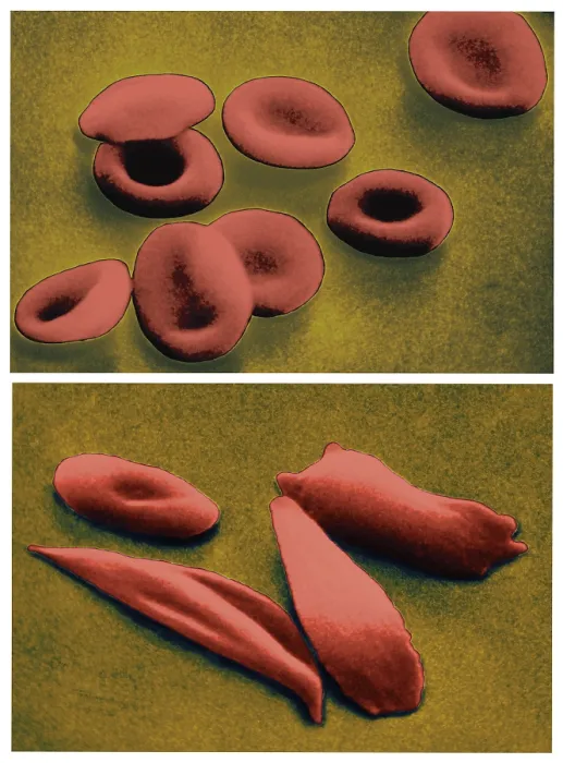 Framed Print : Normal RBCs and Sickle-Cell Anemia, under a microscope (SEM) Framed Print : Normal RBCs and Sickle-Cell Anemia, under a microscope (SEM)