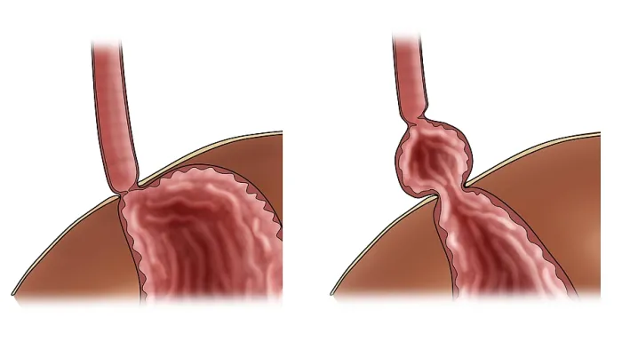Framed Print : Normal Stomach & Stomach with Hiatal Hernia Framed Print : Normal Stomach & Stomach with Hiatal Hernia