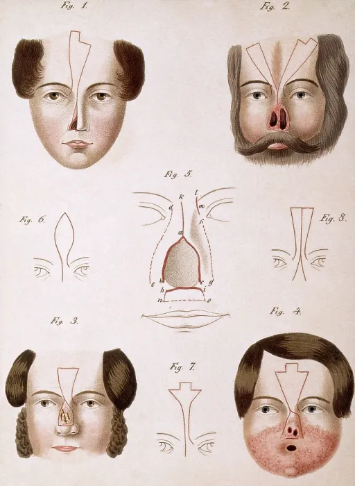 Framed Print : Nose Reconstruction, 1815 Medical Text