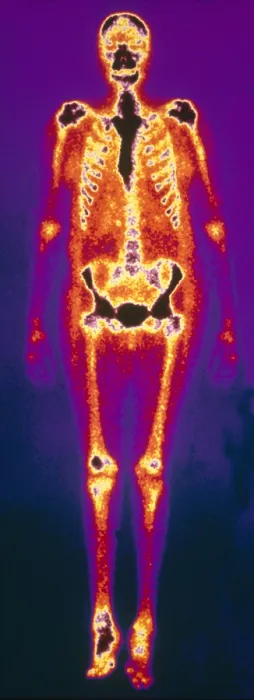 Framed Print : Osteomyelitis Framed Print : Osteomyelitis
