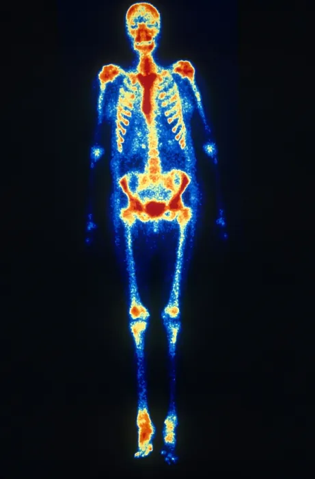 Framed Print : Osteomyelitis Framed Print : Osteomyelitis