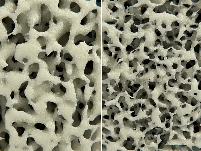 Framed Print : Osteoporosis, healthy (leftI) and osteoporotic (right) bone tissue, Illustration Framed Print : Osteoporosis, healthy (leftI) and osteoporotic (right) bone tissue, Illustration