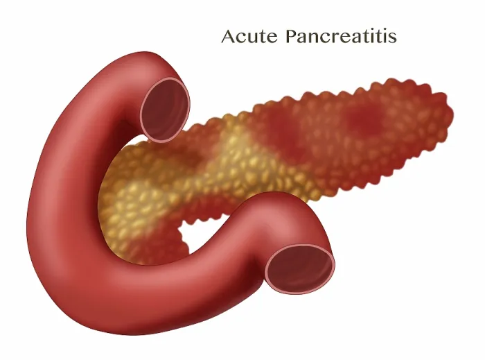 Framed Print : Pancreatitis, Illustration Framed Print : Pancreatitis, Illustration