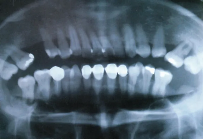 Framed Print : Panoramic Dental X-Ray Framed Print : Panoramic Dental X-Ray