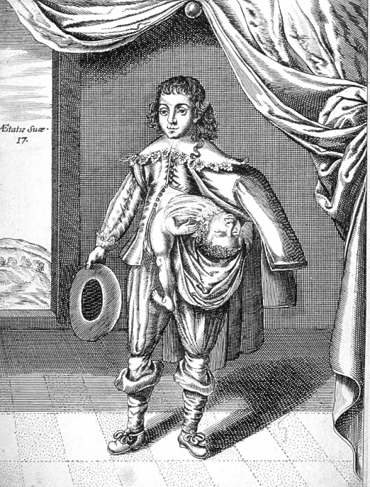 Framed Print : Parasitic Twin, 1686 Framed Print : Parasitic Twin, 1686