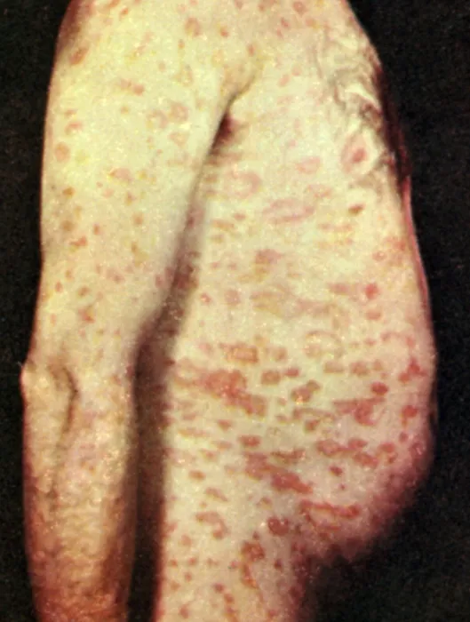 Framed Print : Pityriasis Rosea