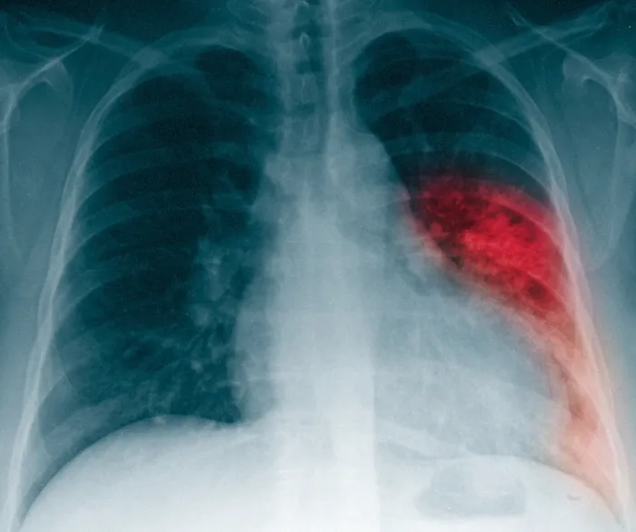 Framed Print : Pneumonia, X Ray