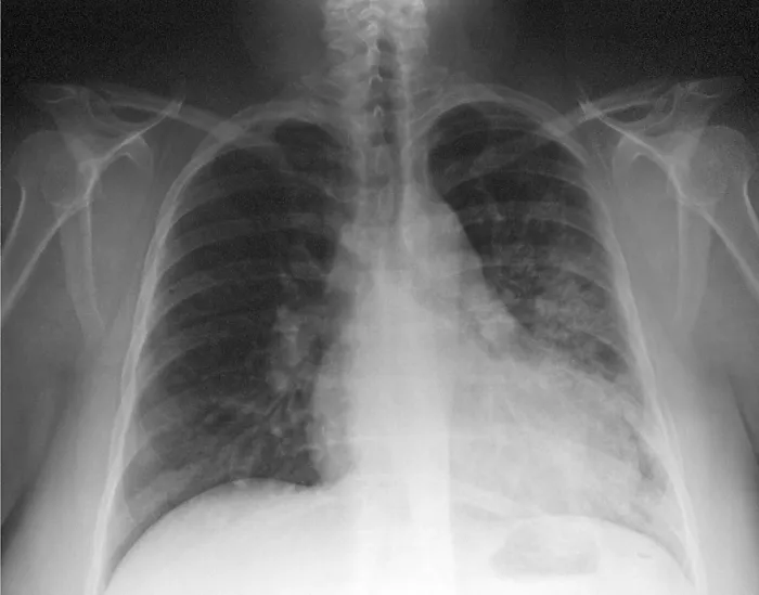 Framed Print : Pneumonia, X Ray