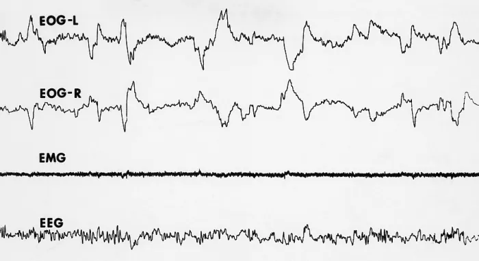 Framed Print : Polygraph Tracings of REM Sleep Framed Print : Polygraph Tracings of REM Sleep