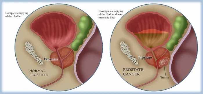 Framed Print : Prostate Cancer, Illustration