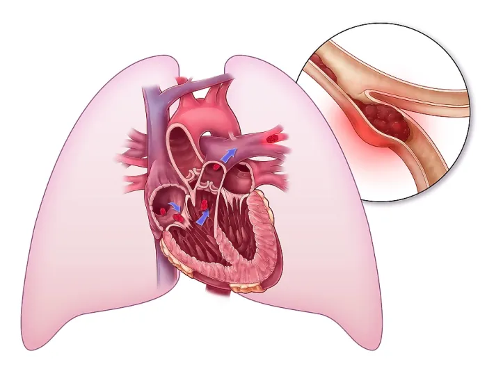 Framed Print : Pulmonary Embolism, Illustration