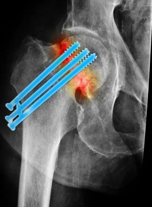 Framed Print : Repaired Hip Fracture Framed Print : Repaired Hip Fracture