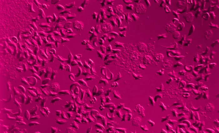 Framed Print : SCD, Sickle-Cell Anemia, light micrograph Framed Print : SCD, Sickle-Cell Anemia, light micrograph
