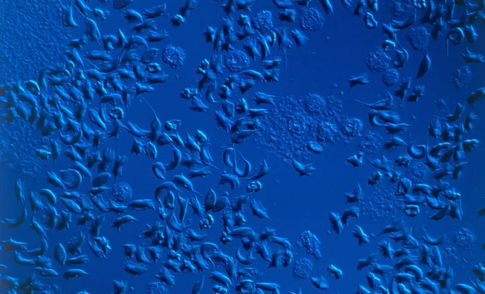 Framed Print : SCD, Sickle-Cell Anemia, light micrograph Framed Print : SCD, Sickle-Cell Anemia, light micrograph