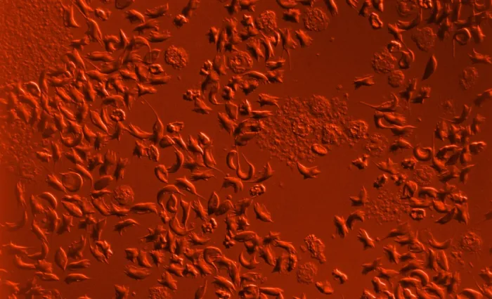 Framed Print : SCD, Sickle-Cell Anemia, light micrograph Framed Print : SCD, Sickle-Cell Anemia, light micrograph