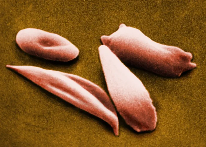 Framed Print : SCD, Sickle-Cell Anemia, under a microscope (SEM)